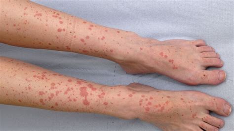 Vasculitis Symptoms Causes And Best Treatment Methods