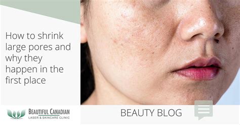 How To Shrink Large Pores And Why They Happen In The First Place