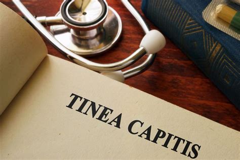 10 Causes Symptoms And Treatments Of Tinea Capitis Health And Detox