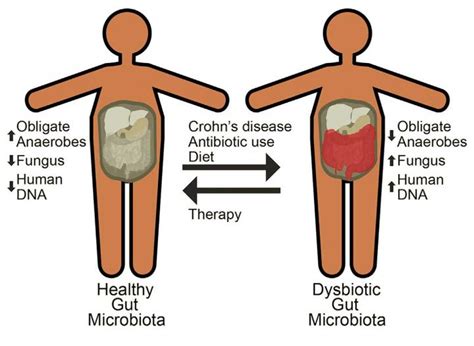 Crohns Disease Treatments Dont Fully Restore Healthy Gut Microbes In