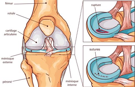 Suture méniscale du genou Dr Michaël Hossenbaccus