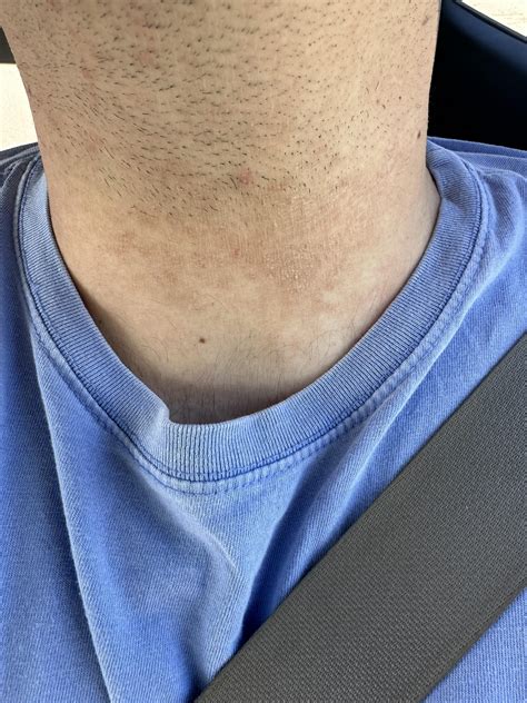 35 Male Scaly And Itchy Patch On My Neck Rdermatologyquestions