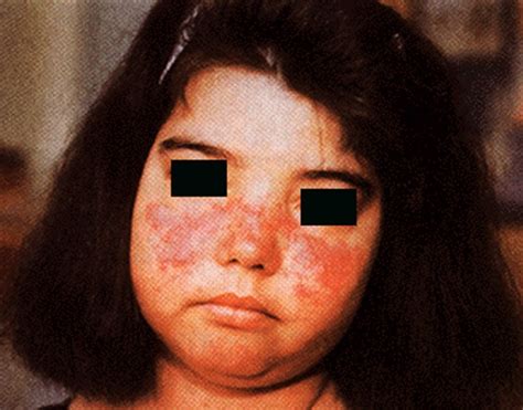 👉 Systemic Lupus Erythematosus Pictures Symptoms Causes Treatment