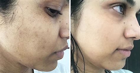 How To Remove Black Spots On Face Get Tips For A Beautiful Face