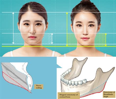 Square Jaw Reduction Procedure Steps Recovery Time Costs And Much