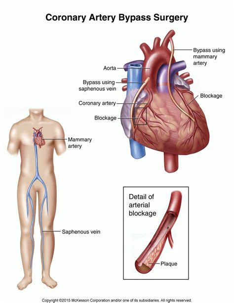 Coronary Artery Bypass Surgery Tufts Medical Center