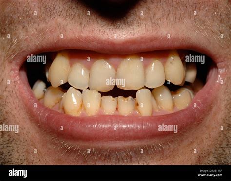 English People Teeth