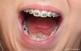 Is There Mercury In Silver Fillings Pictures