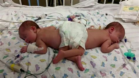 Conjoined Sisters Undergo Rare Separation Surgery Cnn Video