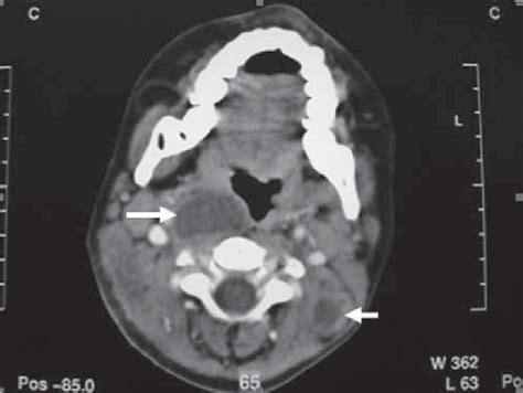 Multiple Cervical Lymphadenopathy On Ct Download Scientific Diagram