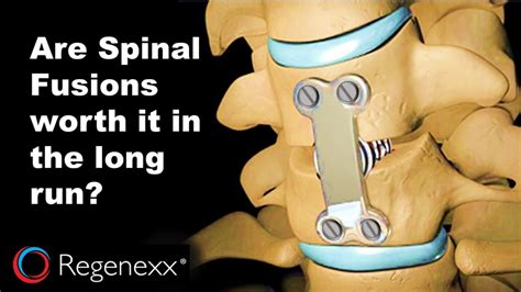 Year Old Spinal Fusion Surgery Before And After Degree Lumbar Hot Sex