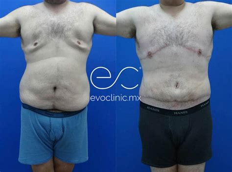 Before And After Enhance Your Appearance Evoclinic