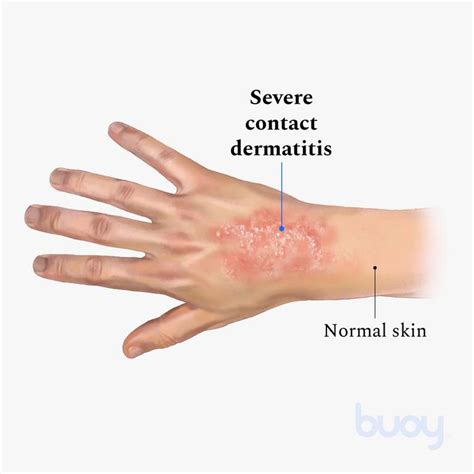 What Is Contact Dermatitis And How To Treat Them Healthcarekite
