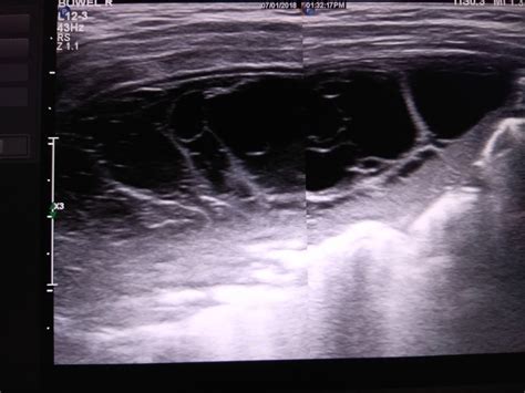 Sono Digest Ultrasound Chest Empyema Thoracis And Enlarged Thymus