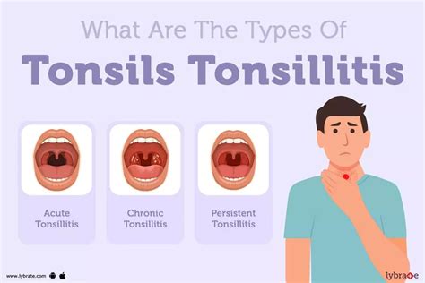Tonsilstonsillitis Causes Symptoms Diagnosis And Treatment