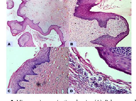Fibroepithelial Polyp Of The Vagina With Fungal Infection Case Report