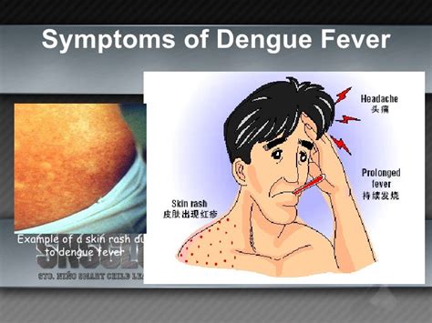 Dengue Fever Rash Features