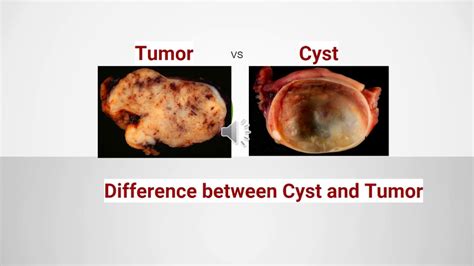 Difference Between Cyst And Tumor YouTube