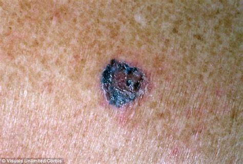 Most Melanoma Patients Have Fewer Than 20 Moles And None That Look