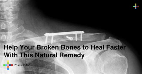 Supplements containing vitamin c, lysine , proline, and vitamin b6 have been shown to reduce discomfort and speed up the healing process. Help Your Broken Bones to Heal Faster With This Natural Remedy
