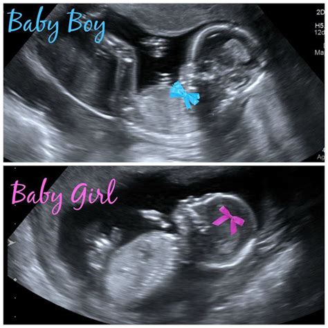 Boygirl Twins 16 Week Bumpdate Arrows And Apricots Cute Pregnancy