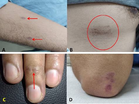 A Maculopapular Erythematous Rash With Scaling Over The Forearm B