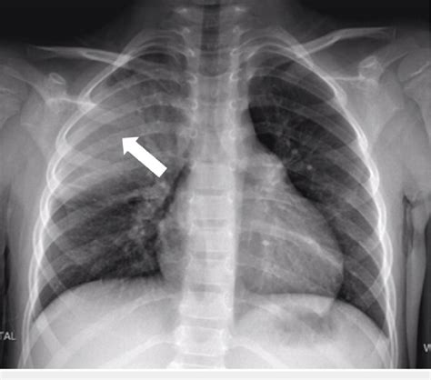 Chest X Ray Large Focal Area Of Consolidation Seen In The Right Upper