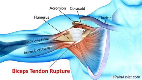 Biceps Tendon Rupture Treatment Exercise Types Causes Distil