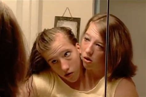 Amazing Facts You Did Not Know About The Most Popular Conjoined Twins