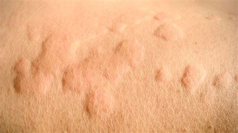 The Symptoms And Treatment Options For Hives Her World Singapore