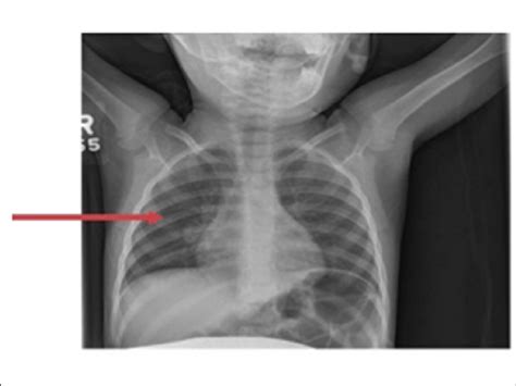Normal Child Chest X Ray