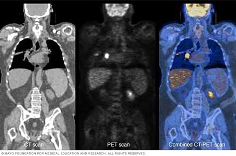 PET CT Scans Aegle Cancer Hospital Mauritius