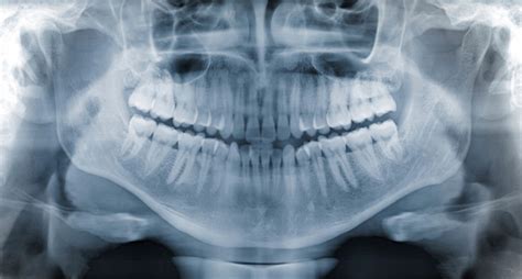 Panoramic Dental Xray Stock Photo Download Image Now Istock