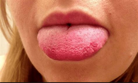 Bumps On Back Of Tongue White Red Black Or Sore Throat