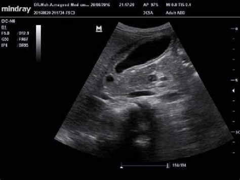 Gallbladder Disease Ultrasound
