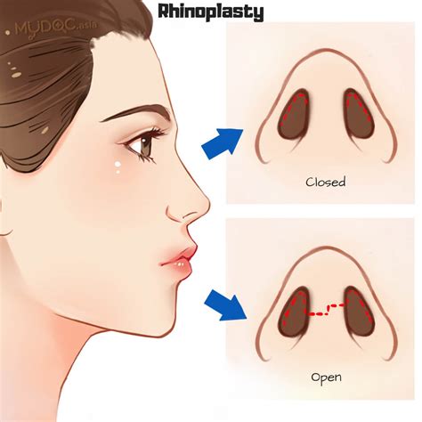 What Are The Different Types Of Rhinoplasty Erufu Care