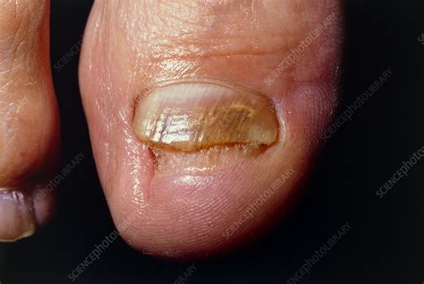 Chronic Fungal Infection Of Toes Stock Image M2700088 Science