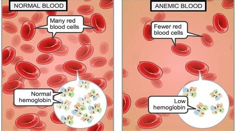 Iron Deficiency Anemia Causes And Symptoms Helal Medical