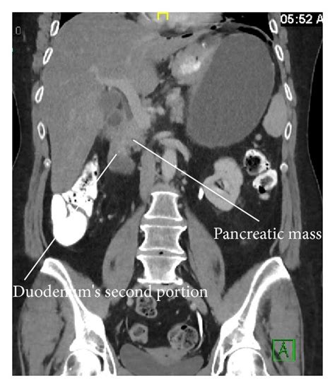 Ct Scan Of Abdomen Showing Moderate To Large Amount Of Intraperitoneal