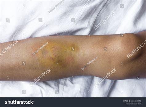 Large Bruise Hematoma On Childs Leg Stock Photo 2031836651 Shutterstock