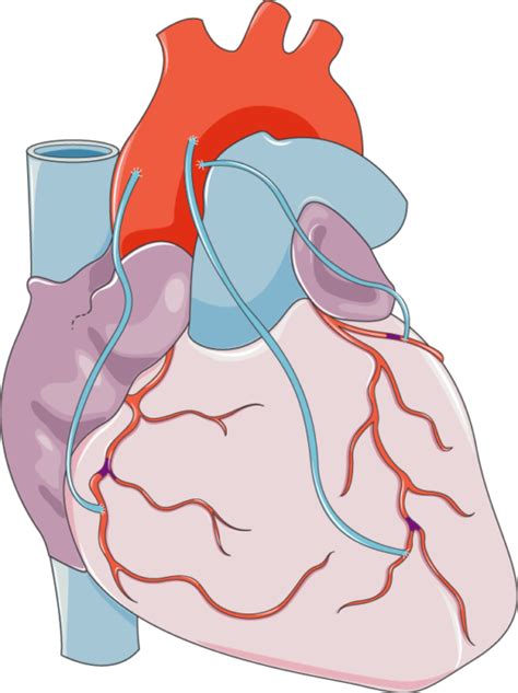 Coronary Artery Bypass Grafting Servier Medical Art