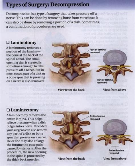 Back Pain Valley Neuro Microneurosurgery S C Oshkosh Wi Laminotomy Laminectomy