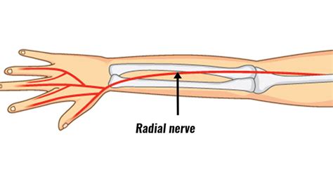 Radial Tunnel Syndrome Symptoms Causes Treatment And Exercises