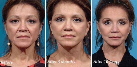 10 Year Facelift Cosmetic Surgery Plastic Surgeon Plastic Surgery