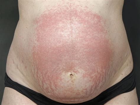 Distended Belly Rash Several Cases Hot Sex Picture