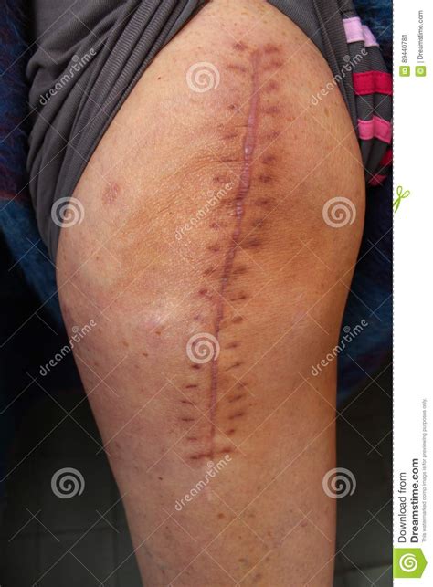 Is there anything i can do to help break the scar tissue ? Total Knee Replacement, Knee Surgery. Stock Image - Image ...