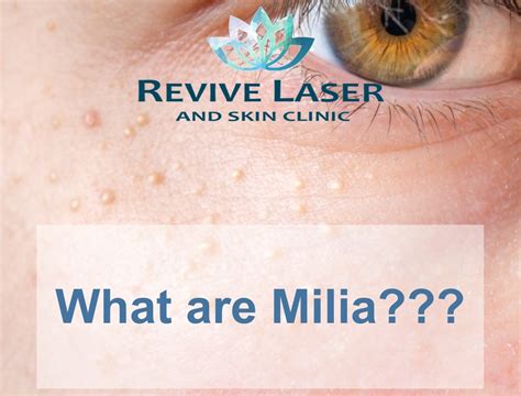 Milia Blog Photo Revive Laser And Skin Clinic