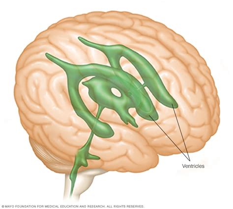 Brain Ventricles Mayo Clinic