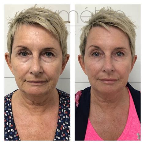 8 Point Face Lift At Symétrie For A Refreshed Non Surgical Facelift