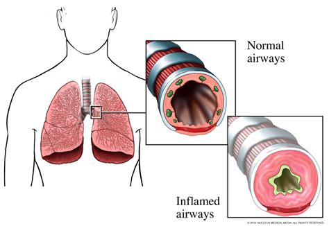 Asthma National Heart Lung And Blood Institute Nhlbi